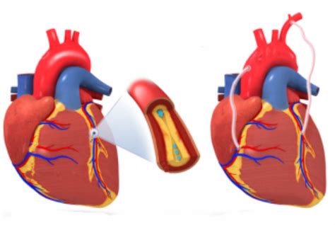 Какво представлява остеохондрозата в сърцето